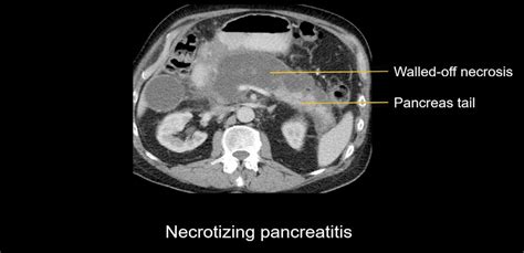 Abdominal CT: necrotizing pancreatitis • LITFL • Radiology Library