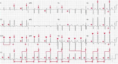 Sinus Tachycardia Inappropriate Sinus Tachycardia – ECG, 50% OFF