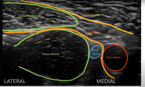 Image Review with Dr. Alyse Volino, Ultrasound Fellow: Fascia Iliaca Block - EM Daily