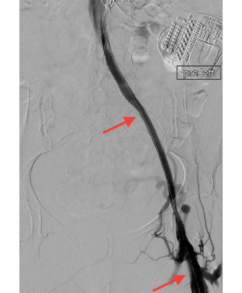 Iliac Vein Anatomy