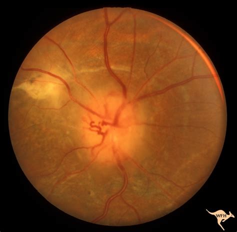 F203 Optic Nerve Sheath Meningioma | Eccles Health Sciences Library | J. Willard Marriott ...