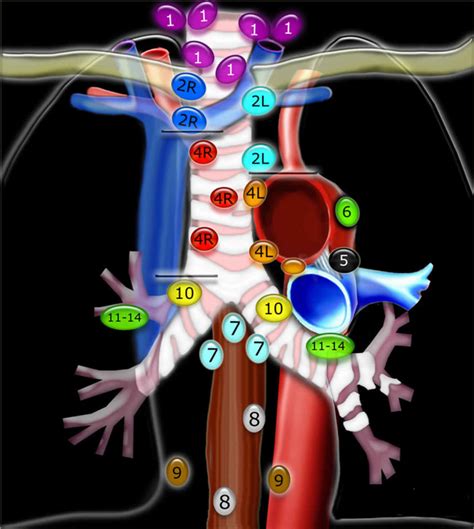 Mediastinal lymph nodes, mediastinal lymphadenopathy causes