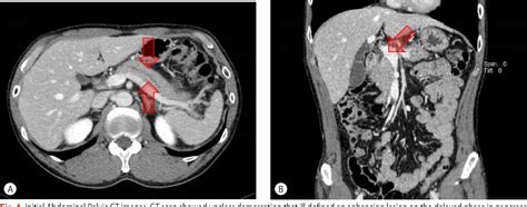 Figure 1 from A Case of Malignant Biliary Stricture Mimicking Benign ...