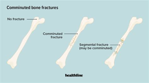 Comminuted Fracture: Causes, Symptoms, and Recovery