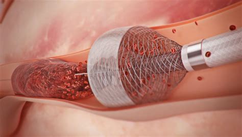 Capture MegaVac Mechanical Thrombectomy System - Speakeasy | Speakeasy