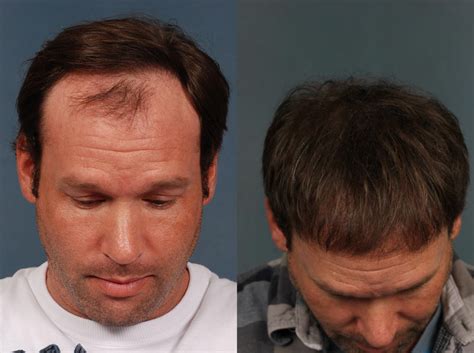 NeoGraft Hair Transplant Before & After Photos Patient 710 | Louisville & Lexington, KY ...