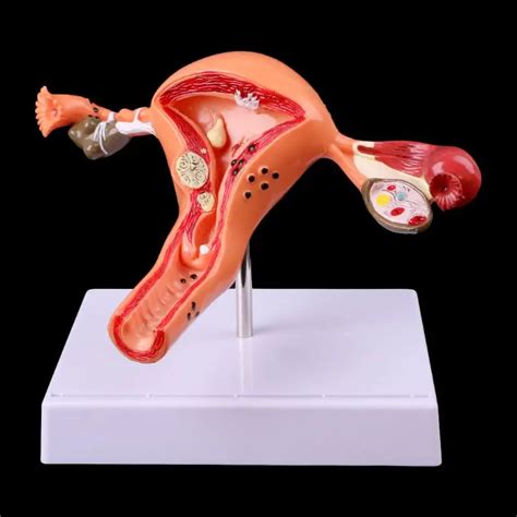 Pathological Uterus Ovary Anatomical Model Anatomy Cross Section Study Tool -in Medical Science ...