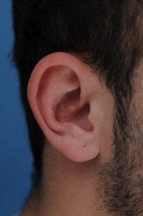 Tumor Symptoms: Tumor Behind Ear Symptoms