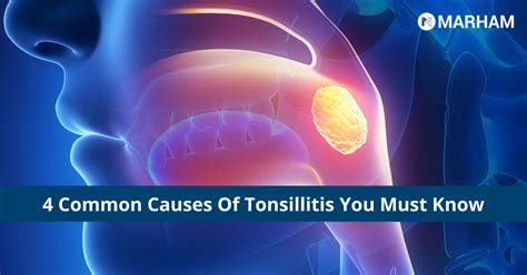 4 Common Causes Of Tonsillitis You Must Know | Marham