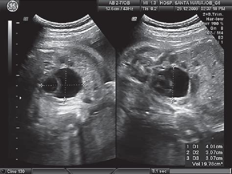 Figure 3 from Ureterocele: Antenatal Diagnosis and Management | Semantic Scholar