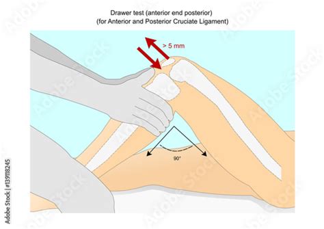 30+ Knee Posterior Drawer Test - KatrynCheryl