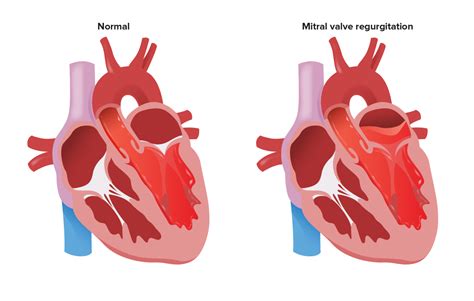 Mitral Regurgitation | Concise Medical Knowledge