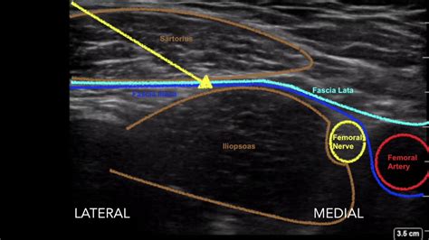 Ultrasound guided femoral nerve and fascia iliaca block - YouTube