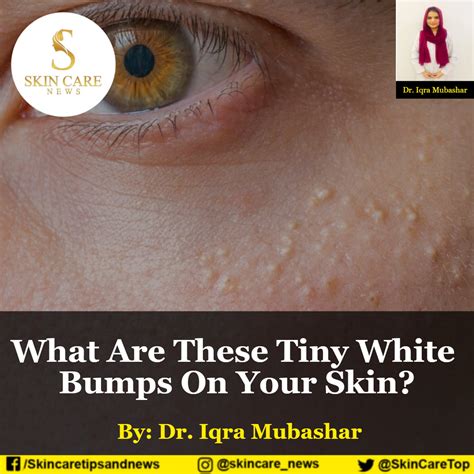 What Are These Tiny White Bumps On Your Skin?