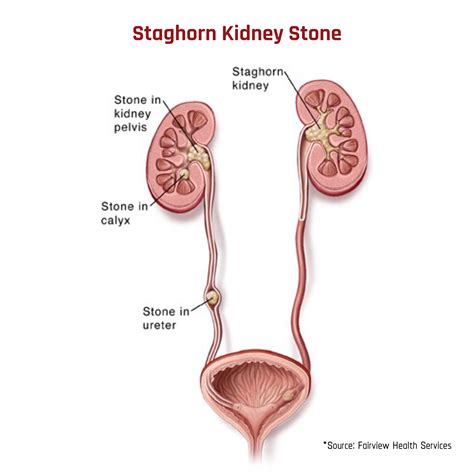 Struvite Kidney Stones: The Bacteria-Based Stone | Stone Relief