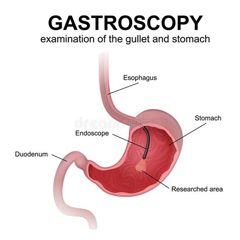 Gastroscopy procedure EGD stock vector. Illustration of digestive ...