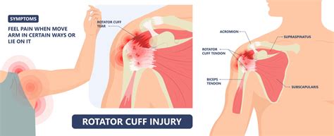 Rotator Cuff Injuries: What You Need to Know - Central Orthopedic Group