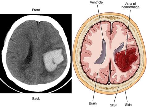 Venous Hemorrhage