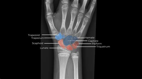 Wrist Examination & Pathology Module - Don't Forget the Bubbles