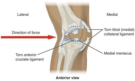 ACL Tear — Plexus Physical Therapy