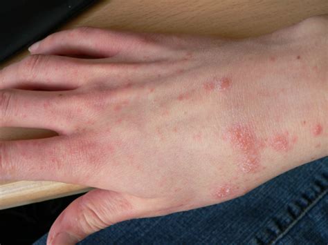 Scabies Treatment You Can Try