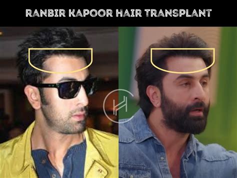 Ranbir Kapoor Hair Transplant - Hair Loss & Technical Analysis