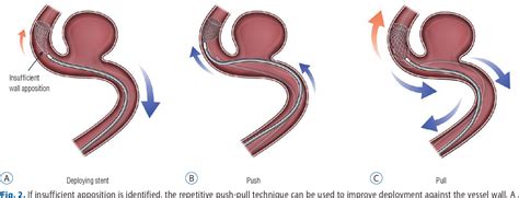 [PDF] The Evolution of Flow-Diverting Stents for Cerebral Aneurysms ...