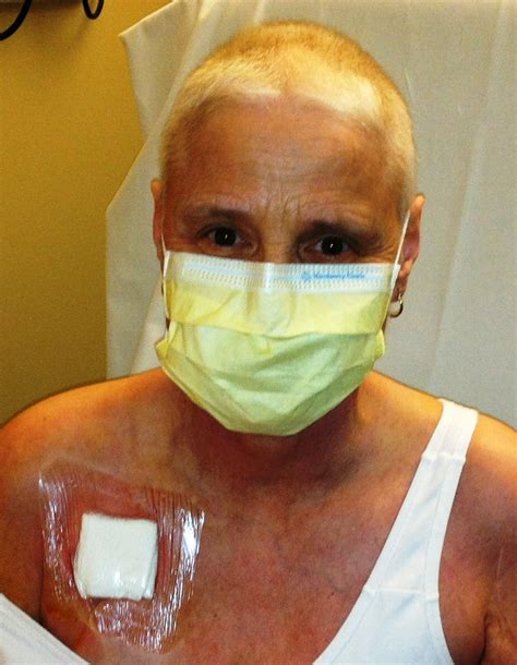 jm's Adventure with Multiple Myeloma: Day 93 - Bard Power Port Removal - December 15 2011