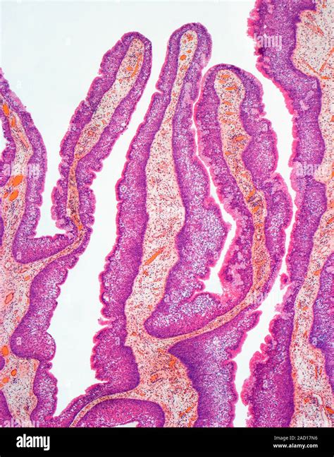 Nasal papilloma. Light micrograph of a section through affected nasal ...