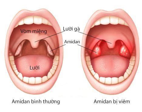 Điều trị viêm amidan cấp bằng thuốc đông y như thế nào?