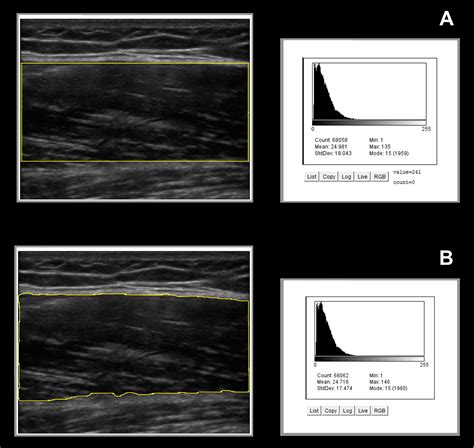 Ultrasound estimates of muscle quality in older adults: reliability and comparison of Photoshop ...