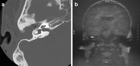 Postoperative middle ear suspected for cholesteatoma recurrence. a... | Download Scientific Diagram