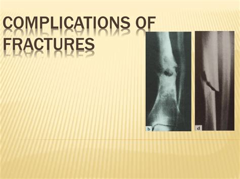 complications of fractures [ppt]