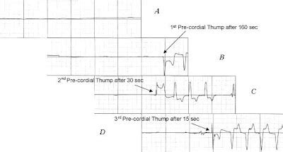 Precordial Thump - For Asystole? - ECG Strips | Paramedicine 101