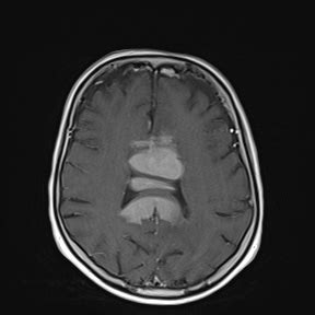 Primary CNS lymphoma (PCNSL) | Image | Radiopaedia.org