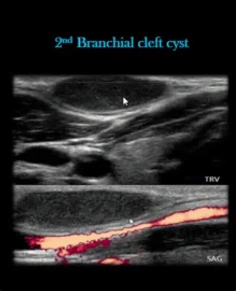 Branchial Cleft Cyst Ultrasound