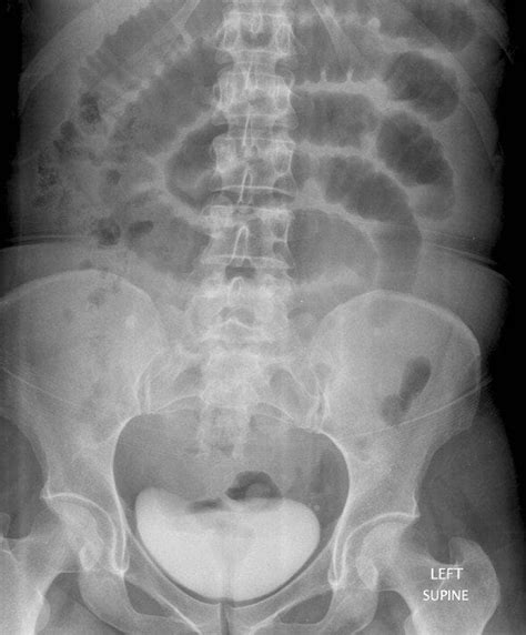 AXR Interpretation • LITFL • CCC Investigations