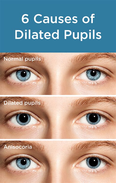 Dilated Pupils: Causes and Concerns | Dilated pupils, Eye health, Eye facts