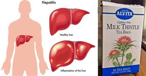 Improve Liver Health With Milk Thistle - Just Naturally Healthy