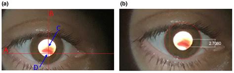 Rizzuti Sign Keratoconus