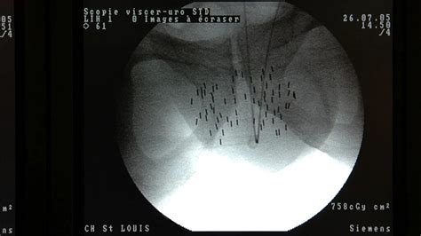 Brachytherapy for prostate cancer: What to expect