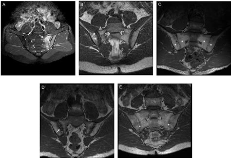 Frontiers | Active Inflammatory and Chronic Structural Damages of ...