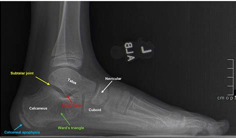 Calcaneal Apophysitis Mri