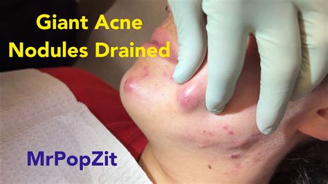 Giant inflammatory hormonal acne nodules drained and injected. - Video ...