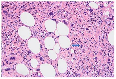 Histology of bone marrow (H&E) showing increased megakaryocytes (blue... | Download Scientific ...