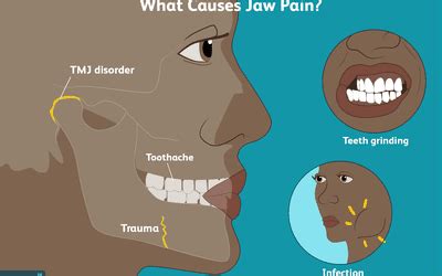 Lockjaw: Overview and More