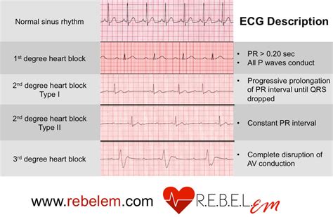 Sinus Bradycardia With First Degree Av Block