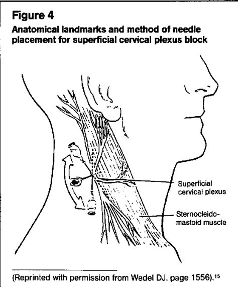 Lírico yeso Supresión cervical plexus block Por separado preocupación ...