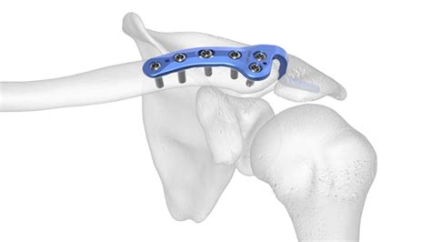 Clavicle Plating System | Acumed