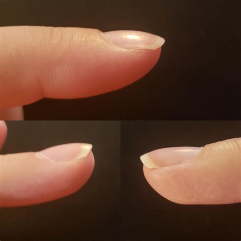 Is this early sign of nail clubbing? I feel like my nails are turning down more than usual. : r ...